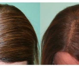 hair surgery for women